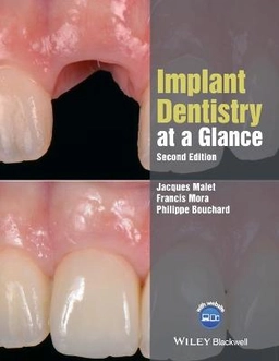 Implant Dentistry at a Glance ; Jacques Malet, Francis Mora, Philippe Bouchard; 2018