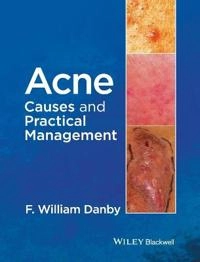 Acne: Causes and Practical Management; F. William Danby; 2015