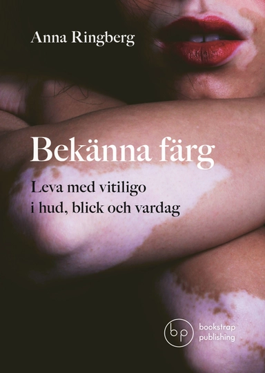Bekänna färg : leva med vitiligo i hud, blick och vardag; Anna Ringberg; 2026