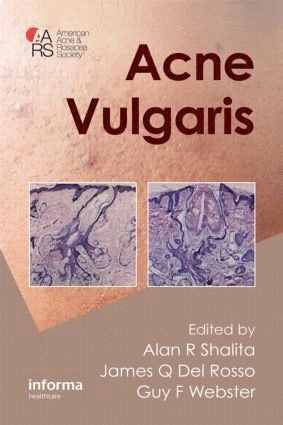 Acne Vulgaris; Alan R Shalita, James Q Del Rosso, Guy Webster; 2011