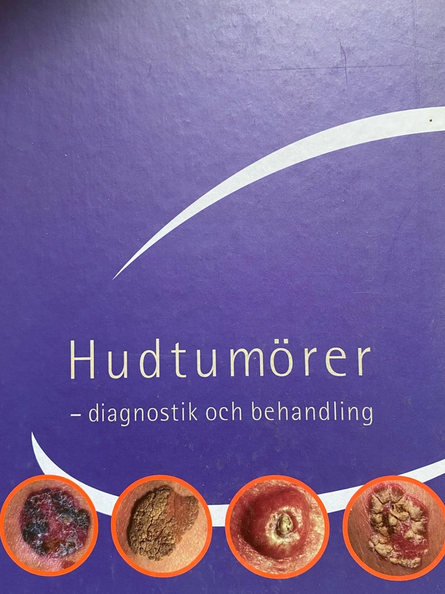 Hudtumörer : diagnostik och behandling; Bo Stenquist, Kjell Hersle, Agneta Augustsson, Fredrik Johansson, Glaxo Wellcome, Glaxo läkemedel
(tidigare namn), Glaxo läkemedel, GlaxoSmithCline
(senare namn), GlaxoSmithCline; 1998